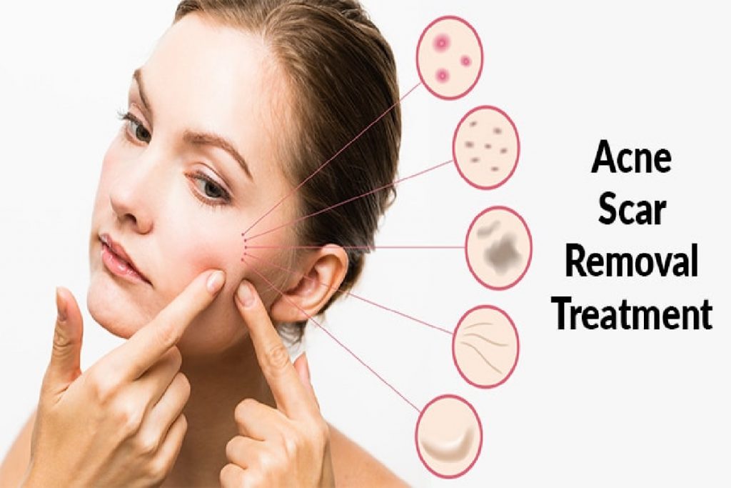 best acne scars treatment