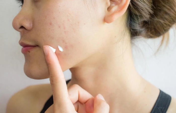 best acne scars treatment