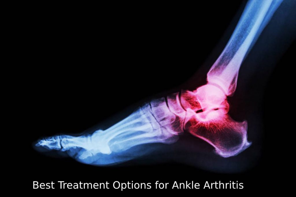 Best Treatment Options for Ankle Arthritis