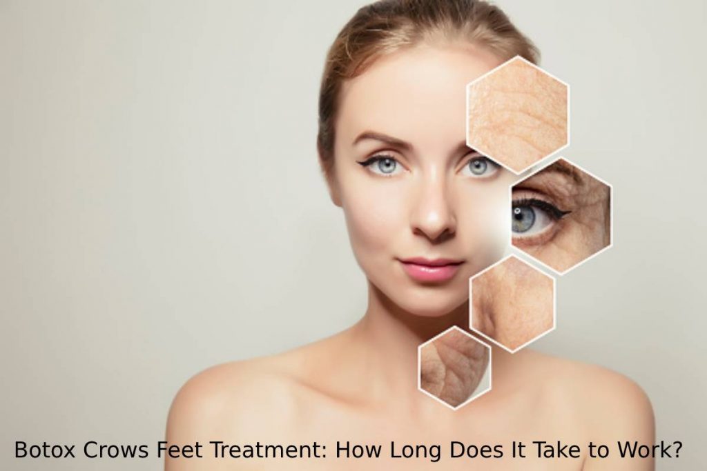 Botox Crows Feet Treatment: How Long Does It Take to Work?