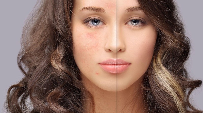 Acne Scars Treatment Write for Us