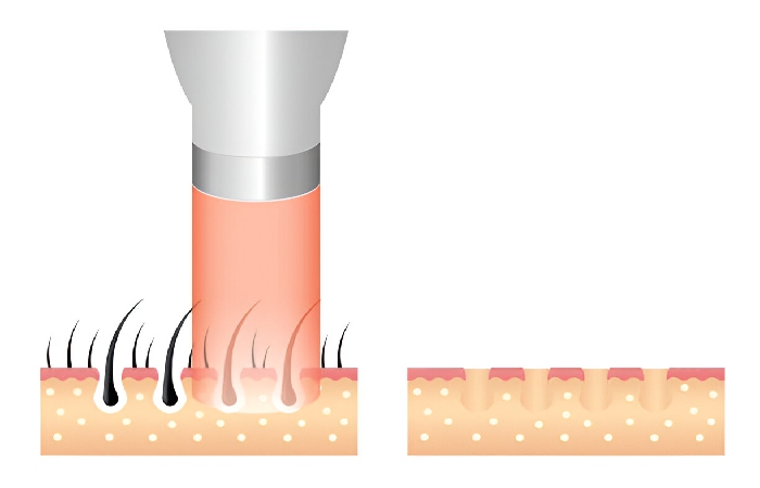 How Hair Eraser Technology Removes Hair